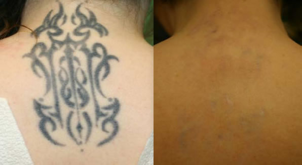 Eliminación de tatuajes - Medstetic Panamá