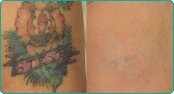 Eliminación de tatuajes - Medstetic Panamá