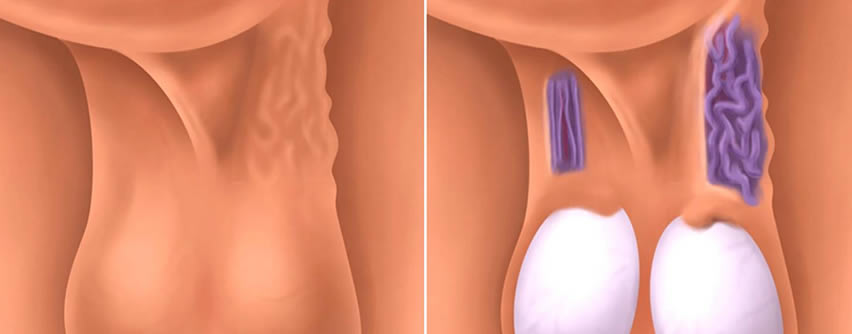 Varicocele: Causas, síntomas y tratamiento – Medstetic Panamá