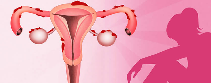 Endometriosis: Síntomas, causas prevención - Medstetic Panamá