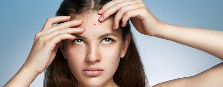 El estrés psicológico como causa del acné