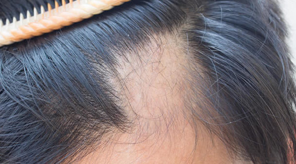 Tratamiento para el eccema podría ser útil contra la alopecia