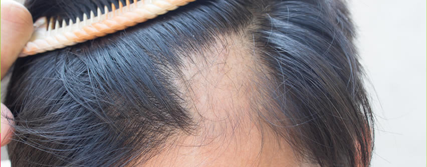 Tratamiento para el eccema podría ser útil contra la alopecia