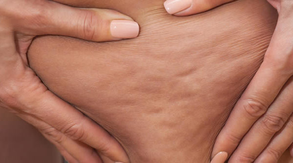 Nuevos métodos para la evaluación de la celulitis