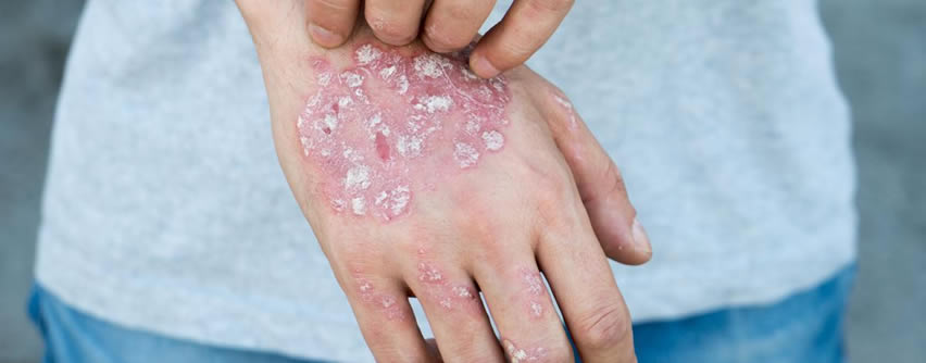 Causas que provocan los brotes de psoriasis