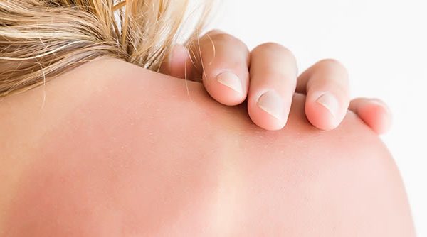 Qué es el golpe de calor y cómo actuar ante su presencia