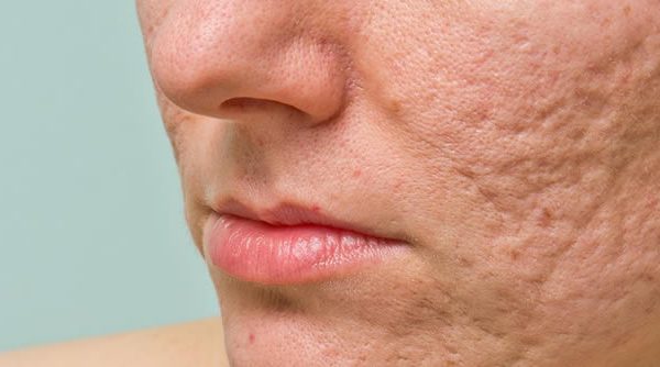 Cicatrices de acné: Causas, tipos