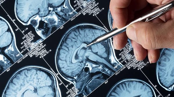 Cómo actuar ante un ataque de epilepsia