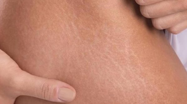 Estrías: Etiología, clínica y tratamiento