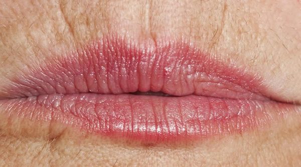 Arrugas peribucales: alternativas actuales de tratamiento