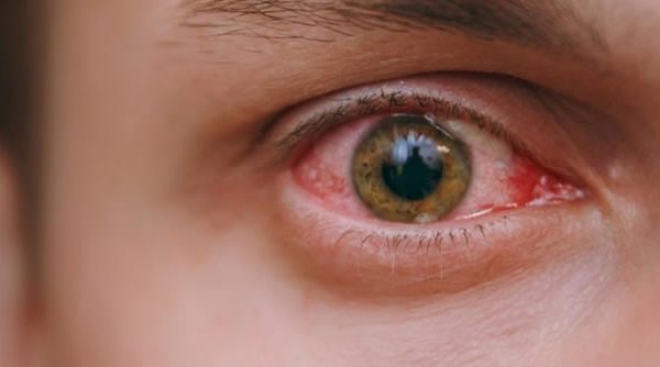 Conjuntivitis: Tratamiento, prevención