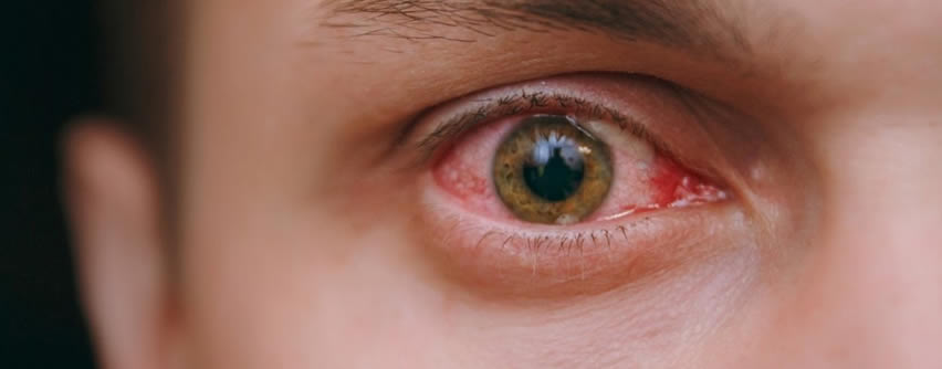 Conjuntivitis: Tratamiento, prevención