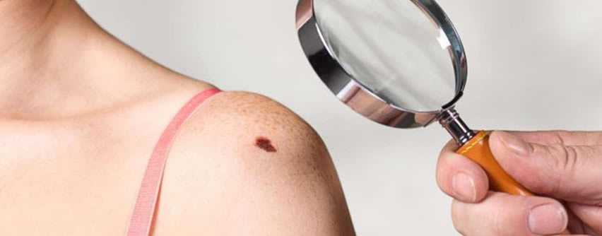 Melanoma: Cuidado con los lunares