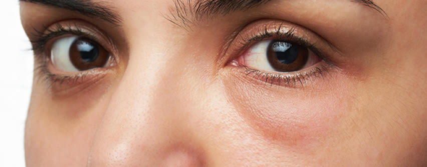 5 opciones muy efectivas para eliminar las ojeras