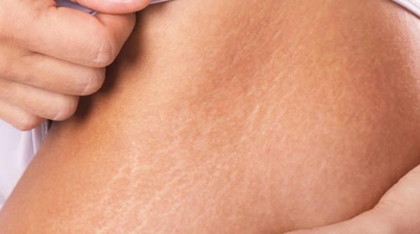 Estrías: Causas, tratamiento preventivo