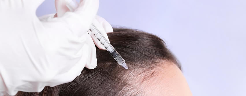 Mesoterapia capilar para frenar la caída del cabello