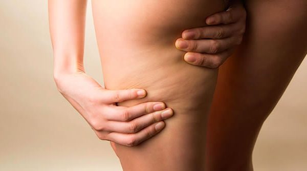 Celulitis: Tipos y tratamientos