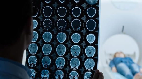 Tratamiento de la hiperglucemia intensivo vs estándar en el ACV