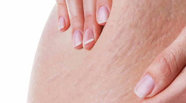 Es posible eliminar la celulitis