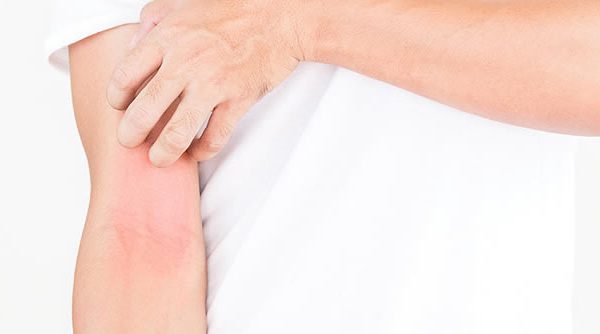 Nuevos fármacos actualizan el tratamiento de la dermatitis