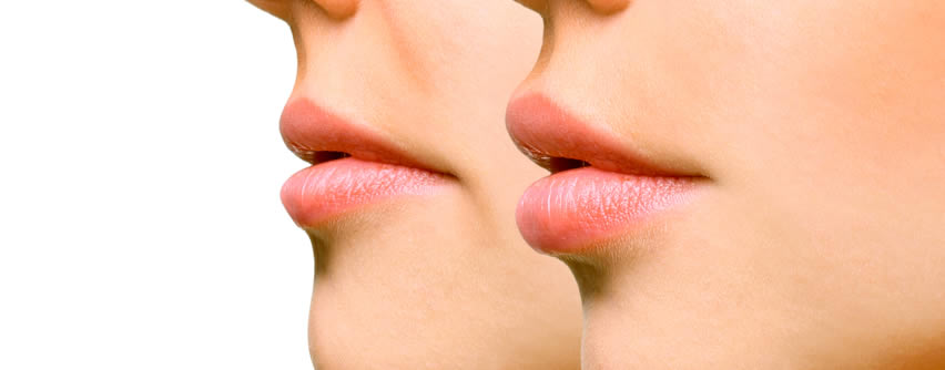 Aumento de labios: los tratamientos con resultados más naturales