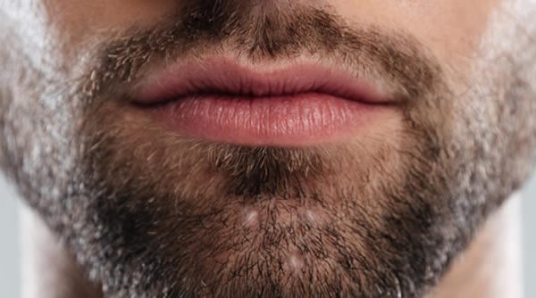 Foliculitis: descripción, síntomas, diagnóstico y tratamiento