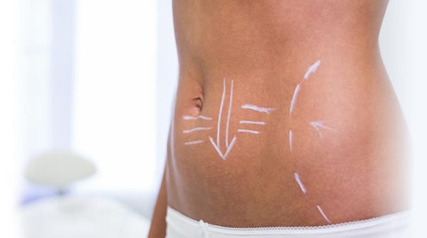Tratamientos estéticos para reducir el abdomen