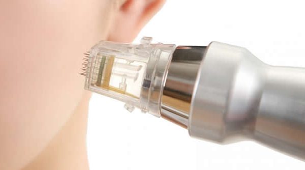 Radiofrecuencia con microagujas