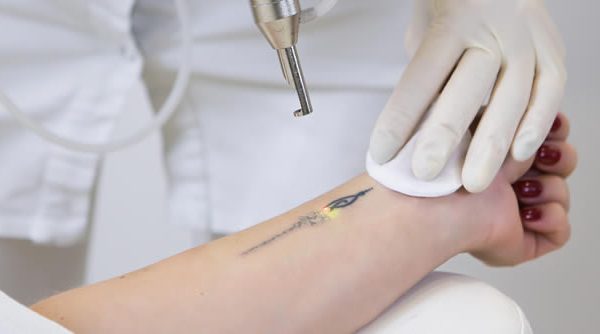 ¿Qué es la eliminación de tatuajes con láser?